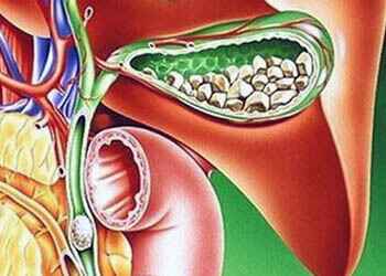 Симптомы холецистита