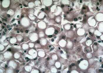 Вирус жирового гепатоза печени