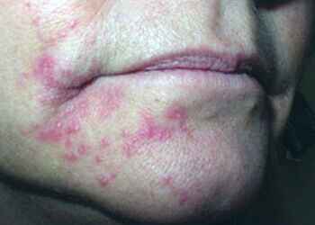 лечение аллергического дерматита