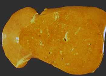 Факторы появления жирового гепатоза Факторы появления жирового гепатоза