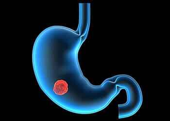 лечение ахалазии пищевода