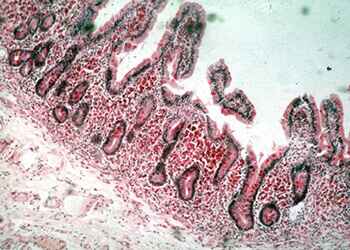 Болезнь Уиппла