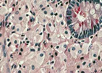 лечение болезни Уиппла