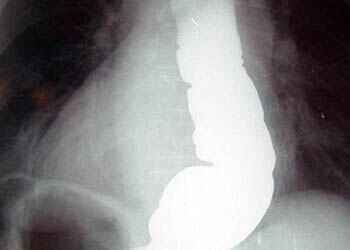 лечение ахалазии