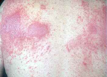 как лечить аллергический дерматит