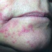 Лечение аллергического дерматита