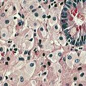 Лечение болезни Уиппла