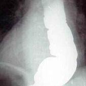 Лечение ахалазии