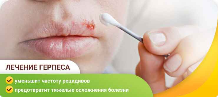 Лечение герпеса Лечение герпеса
