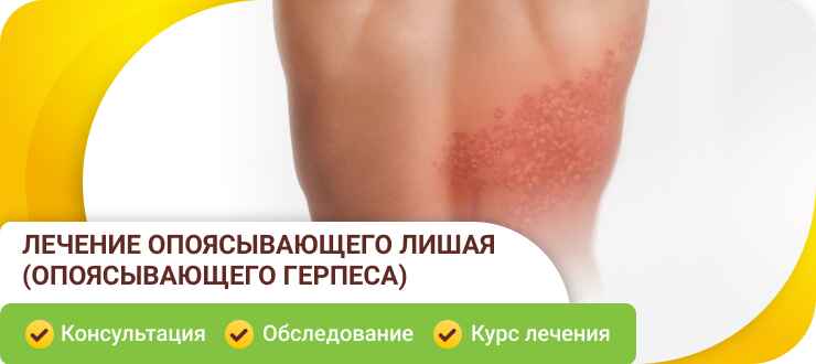 Лечение опоясывающего лишая