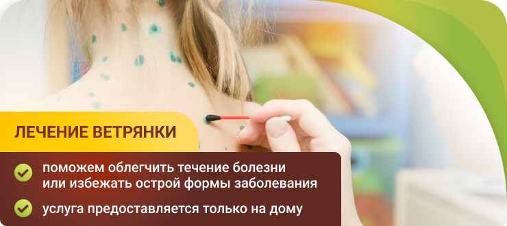 Лечение ветрянки