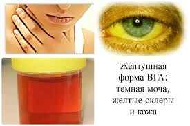 Симптомы гепатита А