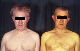 Течение гепатита А