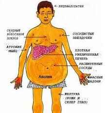 Симптомы цирроза печени 