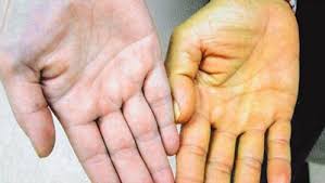 Симптомы фиброза