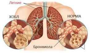 Болезнь органов дыхания