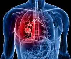 Воспаление органов дыхания