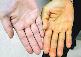 Проявление синдрома Жильбера