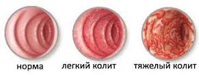 Виды колита