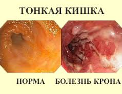 Формы болезни Кроны