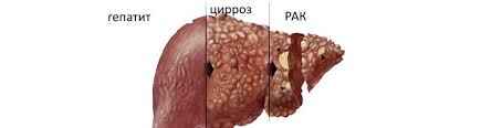Поражение печени при разных заболеваниях