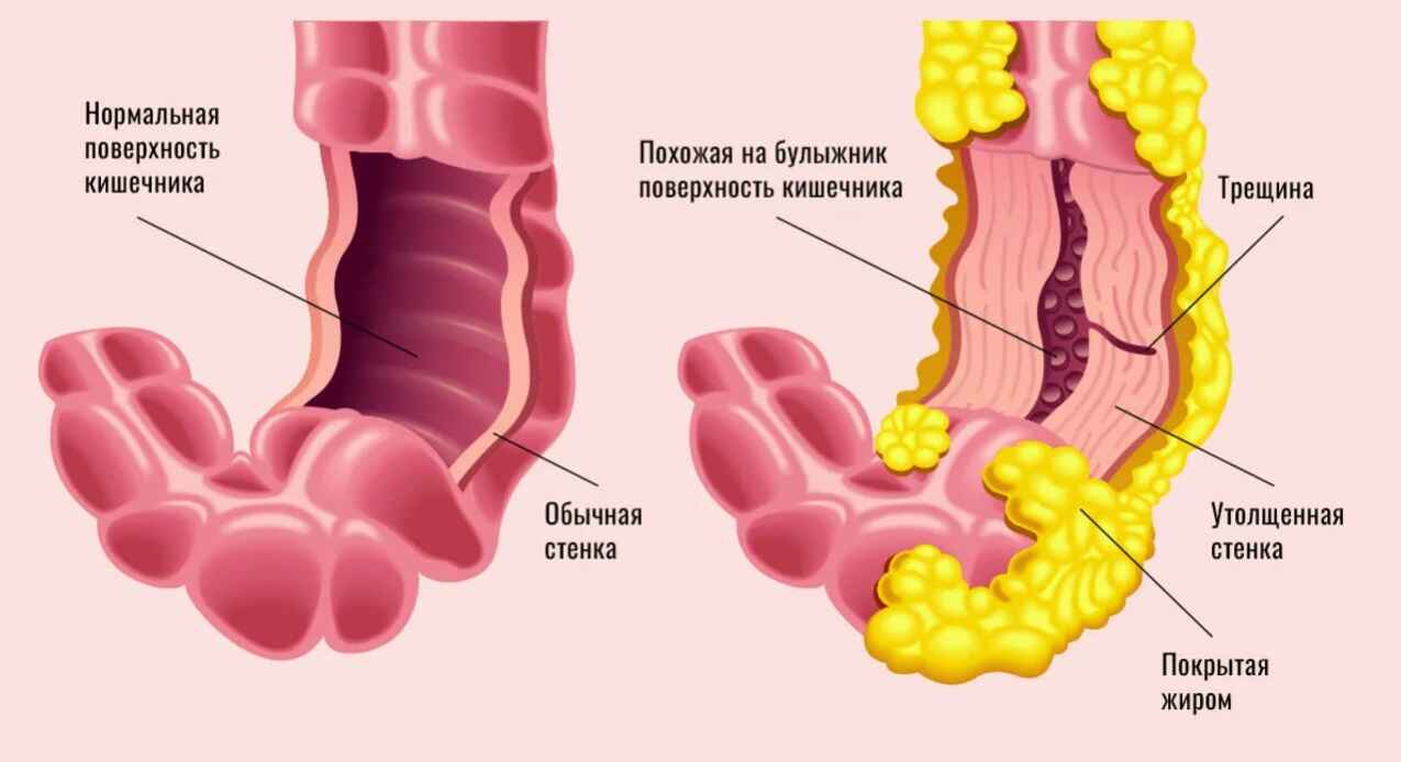 Лечение воспаления кишечника и болезни Крона