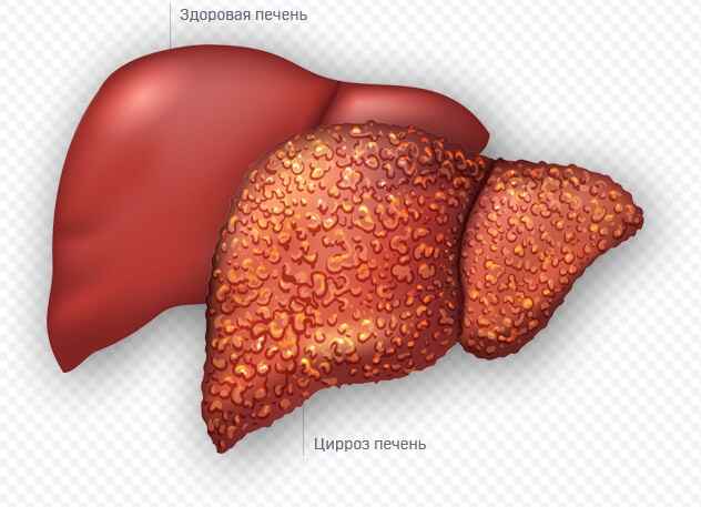 Лечение цирроза печени