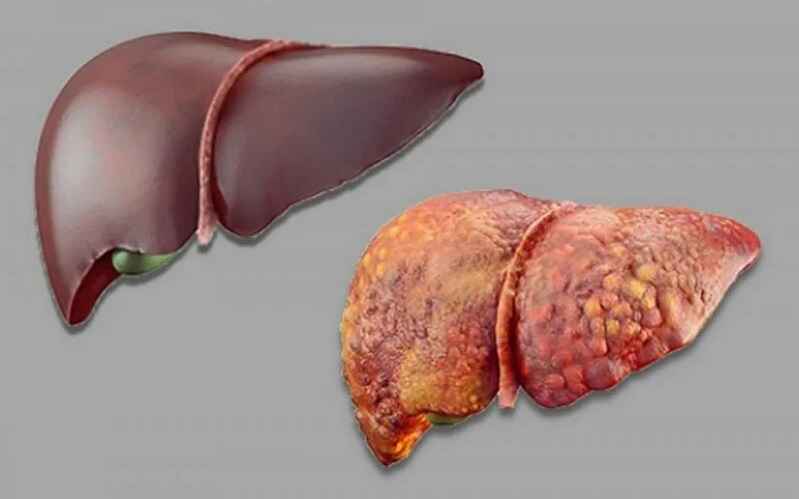 Повреждение печени 