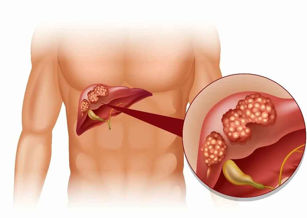Диагностика рака печени