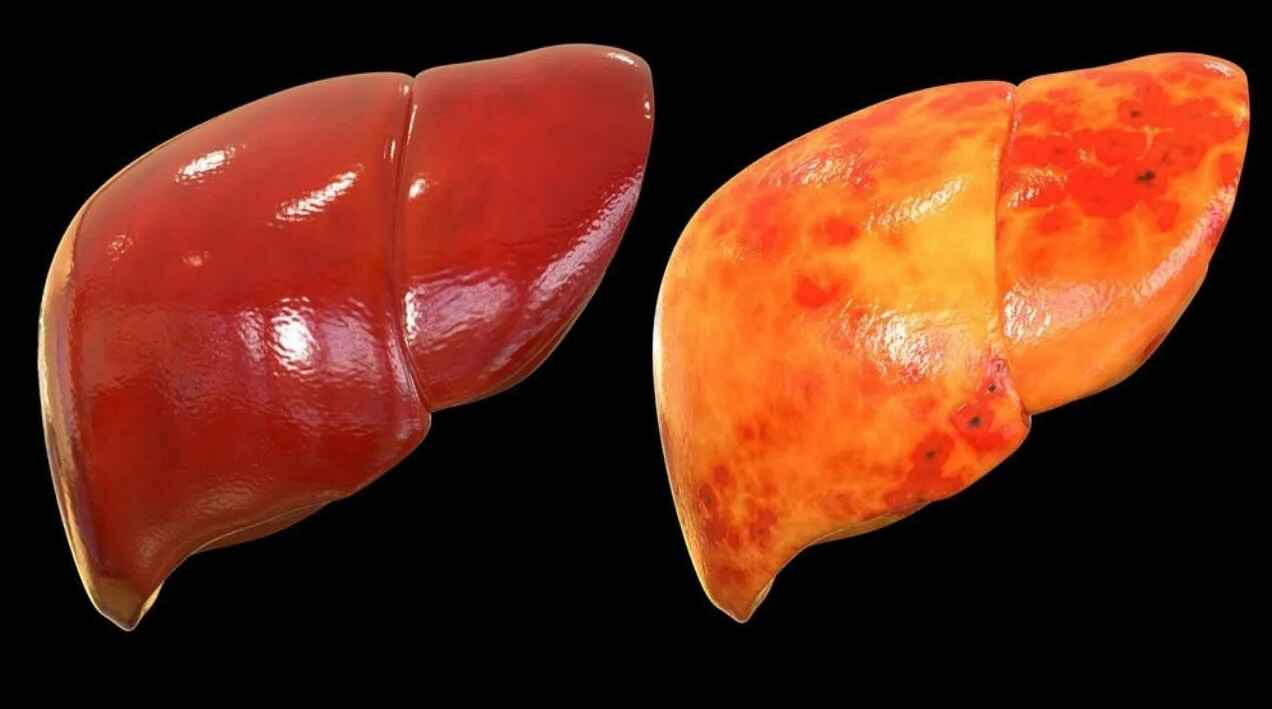 Диагностика стеатоза