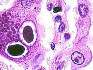 Цитомегаловирус лечение цитомегаловируса