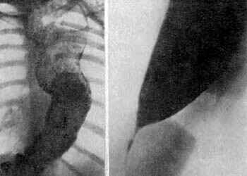 лечение ахалазии кардии