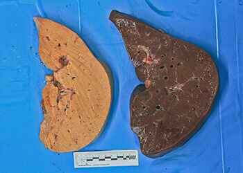 Деградация печени при гепатозе Деградация печени при гепатозе