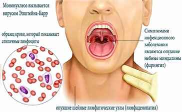 Симптоматика и лечение вируса Эпштейна Барра у взрослых и детей