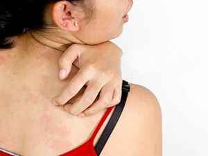 Типы герпеса