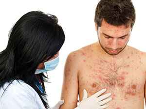 Поражение кожи при герпесе Симптомы герпеса