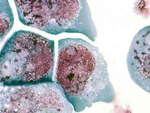 Лечение острой формы герпеса 6 типа