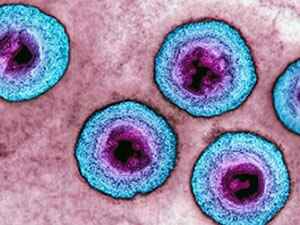 Герпесвирусная инфекция