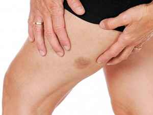 лечение Саркома Капоши